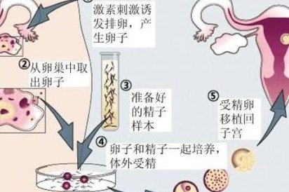 在美国做事三代试管需要多少钱_在美国做事三代试管婴儿需要多少钱？