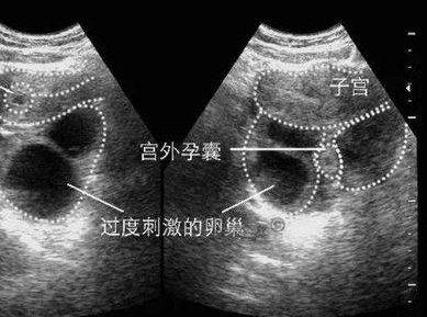 y染色体微缺失做试管婴儿可以吗？附上方法和风险